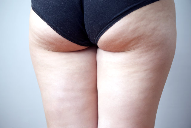 Cellulite_01